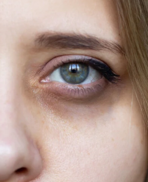 Periorbital Hyperpigmentation